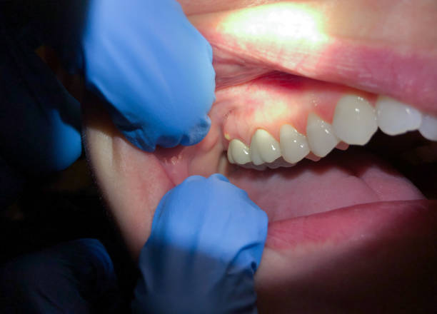 Best Urgent Care for Lost Fillings or Crowns in Cleveland, FL